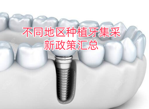 不同地区种植牙集采新政策汇总