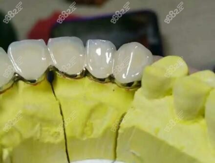 鈷鉻合金烤瓷牙圖片