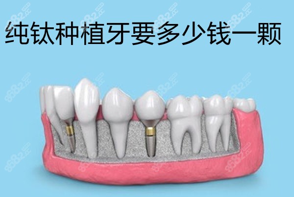 纯钛种植牙要多少钱一颗