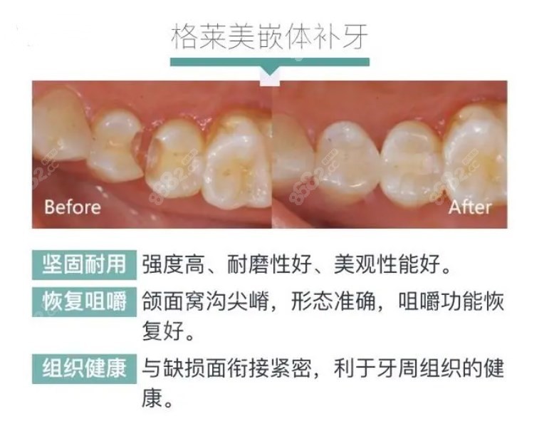 瓷嵌体补牙