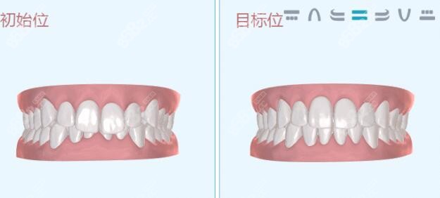 深圳南山区牙齿矫正好的医院名单