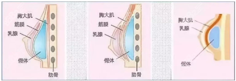 假体隆胸