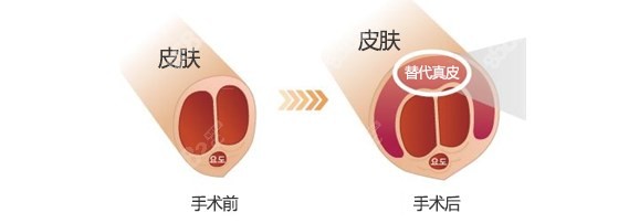 韩国世檀塔男科医院增粗图片