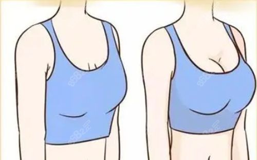 乳房花苞术和双环乳房悬吊术的区别3是术后成效不同