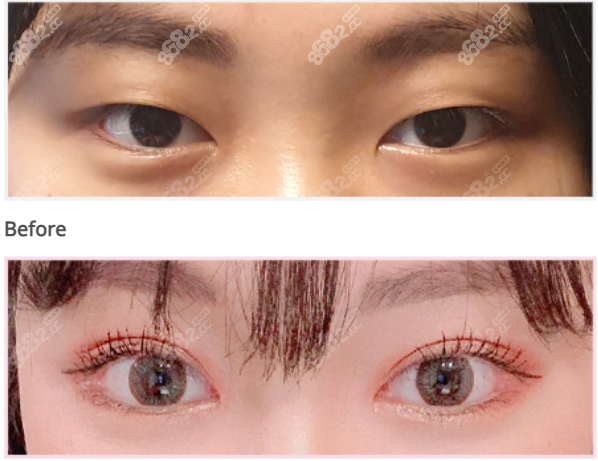 韓國綺林外眼角下至實例圖