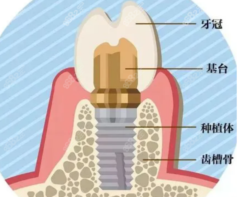种植牙
