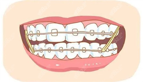 牙齿矫正动画示例图
