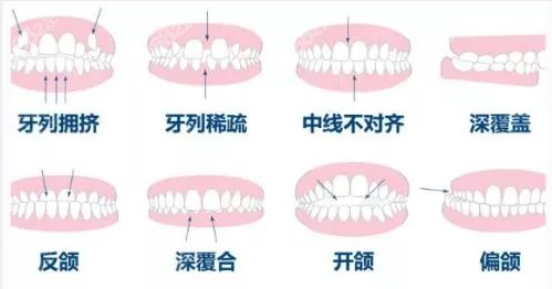 牙齿矫正修复要多少钱