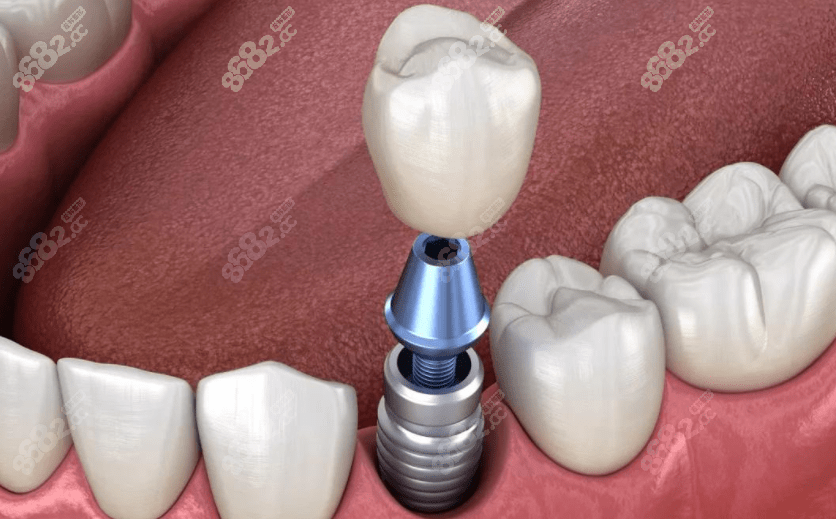 韩国奥齿泰种植牙使用寿命是多久8682cc