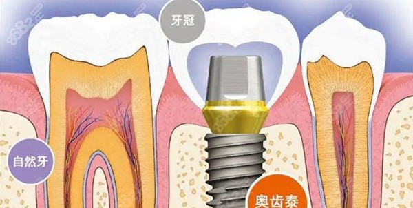 韩国奥齿泰种植牙质保期多久