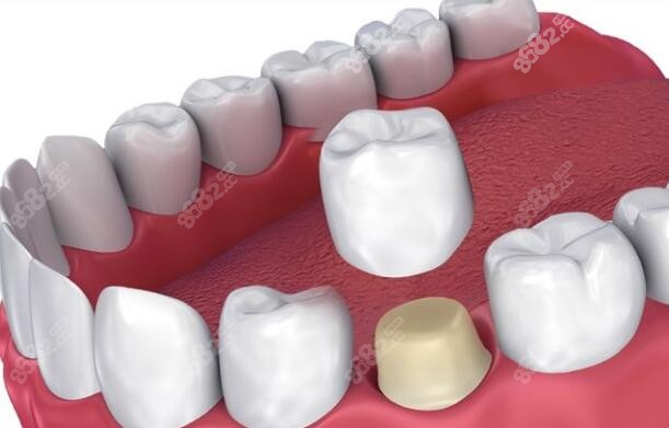 怀化沅陵牙科医院种植牙多少钱一颗价格