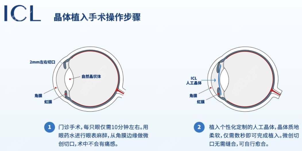 国内ICL人工植入晶体手术费用2万起