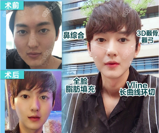 韓國綺林磨骨手術(shù)對比圖