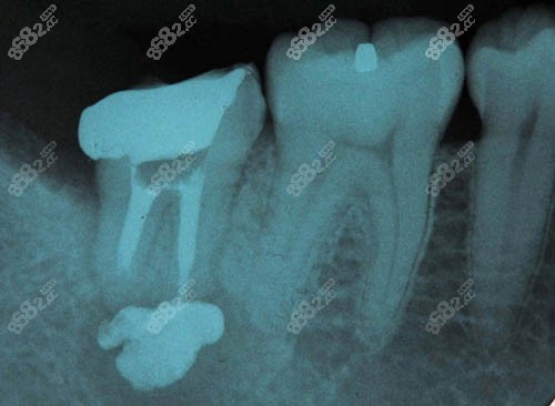 牙齿根管治疗ct照片