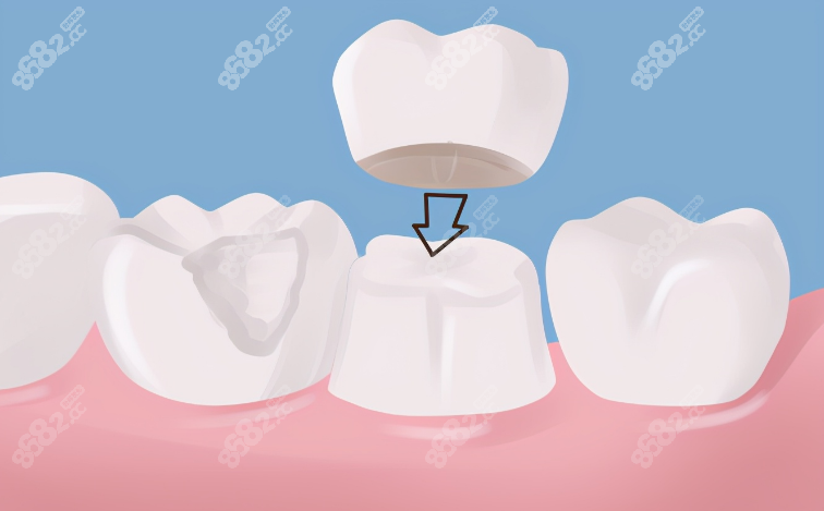 牙齿美容冠修复多少钱一颗牙