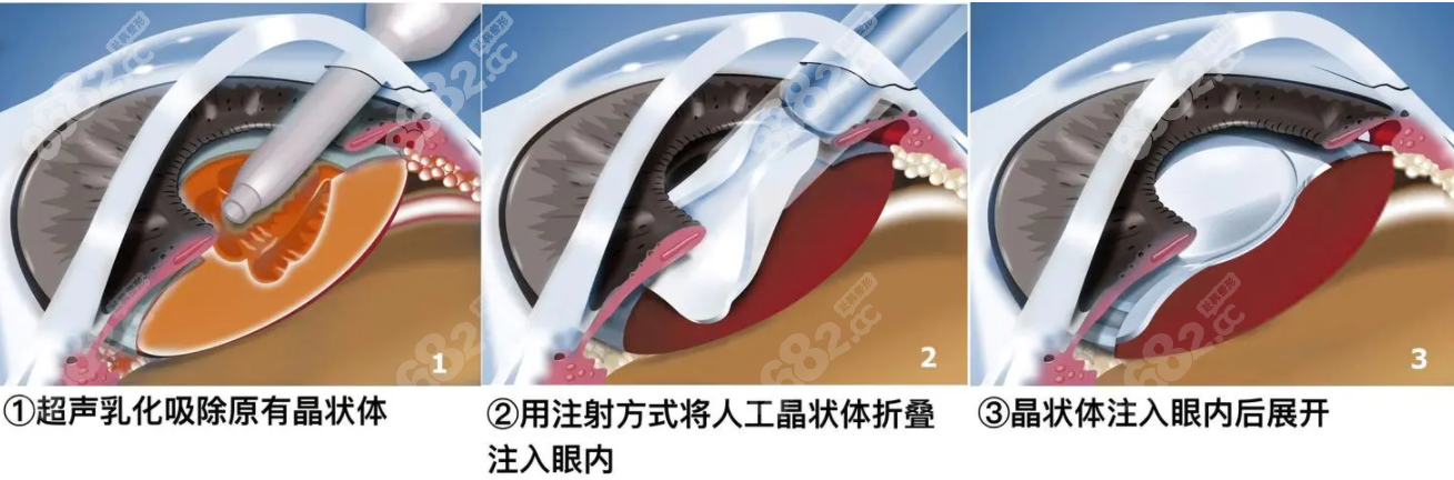 人工植入晶体手术过程8682.cc