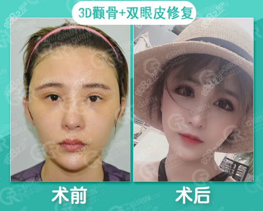 韓國綺林眼修復實例對比圖