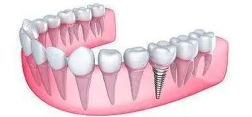种植牙图片