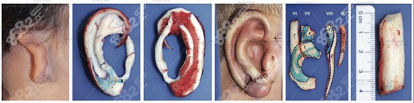 广州余文林耳朵再造怎么样