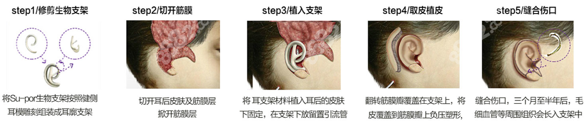 郭志华医生人工支架耳再造形态逼真8682.cc