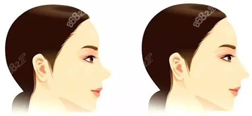 自體軟骨隆鼻動畫圖