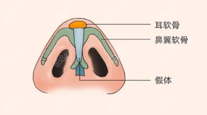 李信锋医生隆鼻