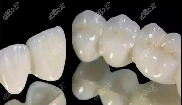 常見的全瓷牙冠有哪幾種