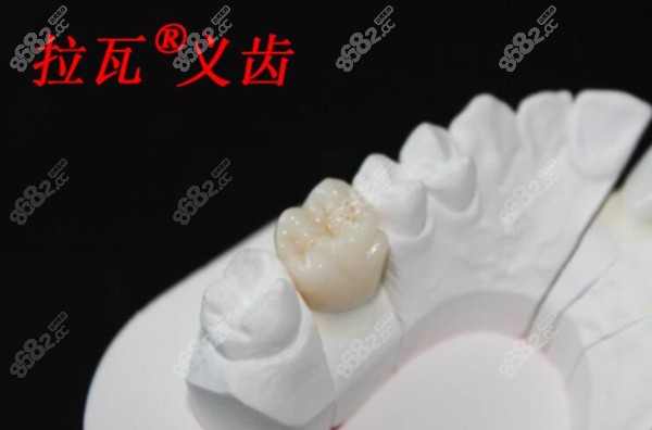 牙冠模具圖