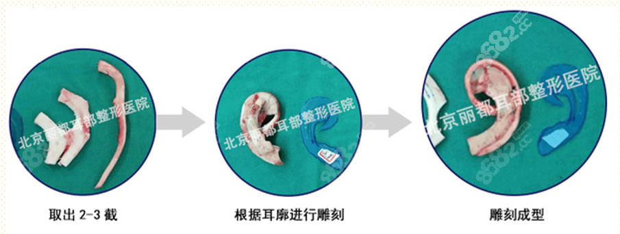 庄洪兴医生肋软骨耳再造手术过程