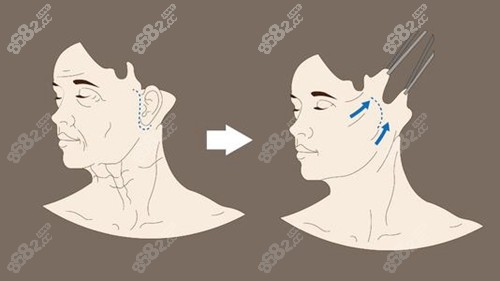 韩国普罗菲耳整形外科医院拉皮手术