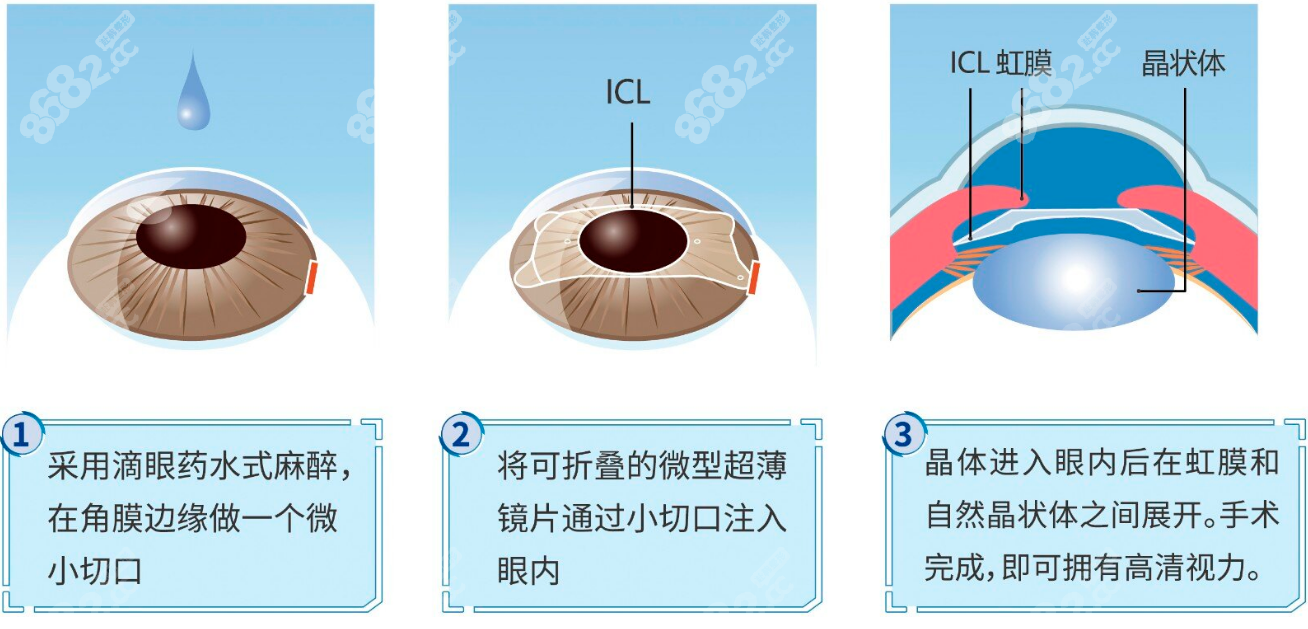 高度近视可以做手术治疗吗?近视1800度内可以做晶体植入治疗