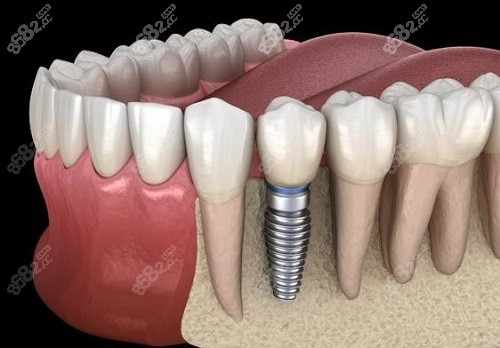 青岛优诺口腔医院种植牙怎么样