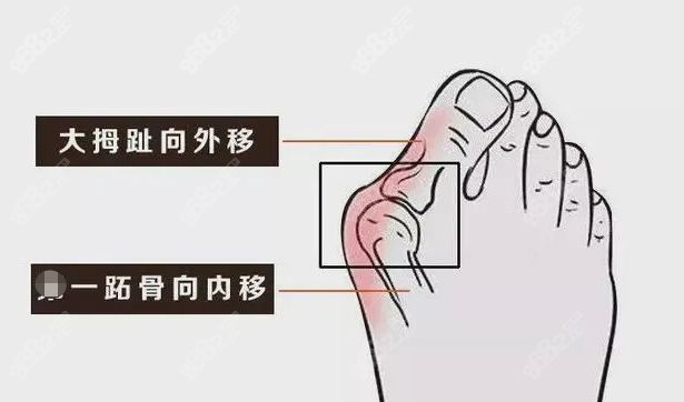 苏敬达做微创拇外翻手术好