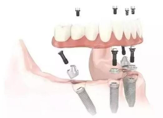深圳龙岗区半全口种植牙价格表