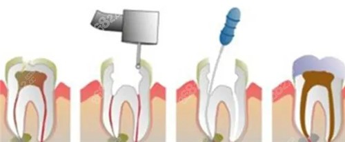 牙齿根管治疗动画图