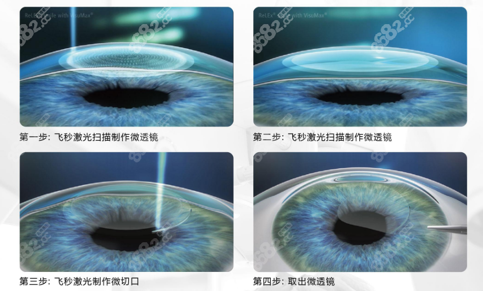 高度近视可以做手术治疗吗？可以