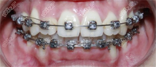 牙齿金属矫正过程图