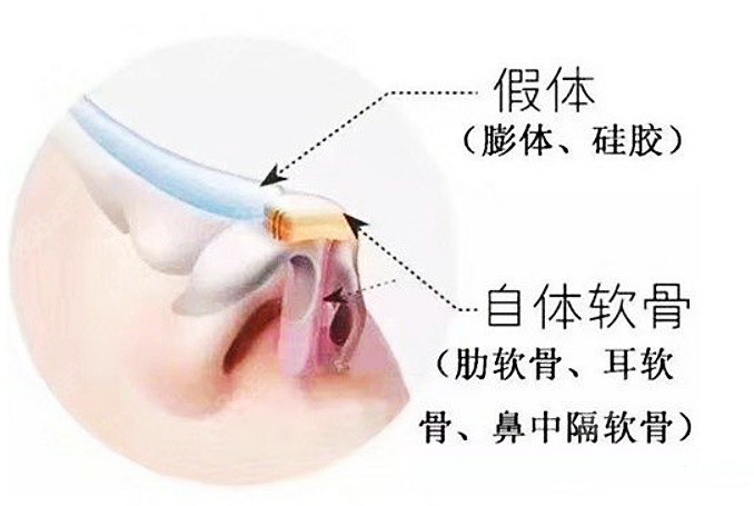 耳软骨隆鼻常见鼻综合手术www.8682.cc