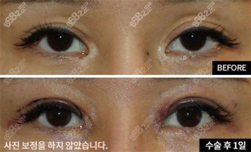 韩国爱护整形医院肉条感双眼皮修复照片分享