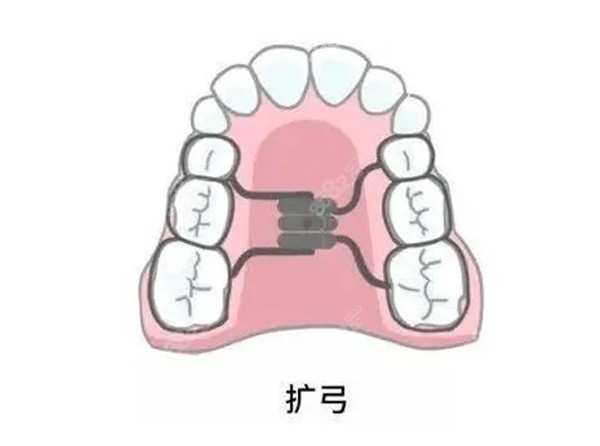 牙齿拥挤不拔牙矫正方式1：扩弓