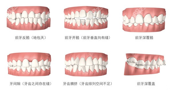 牙齿拥挤不拔牙正畸的优点8682.cc