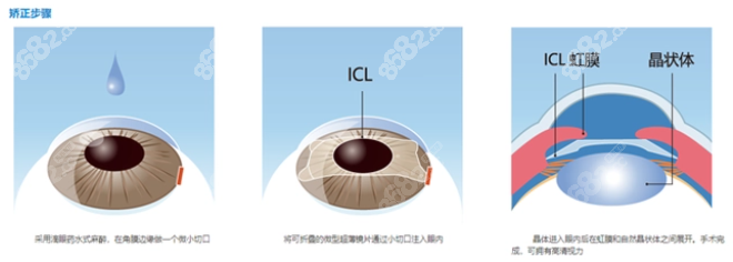 近视做icl晶体植入费用25000-40000元起