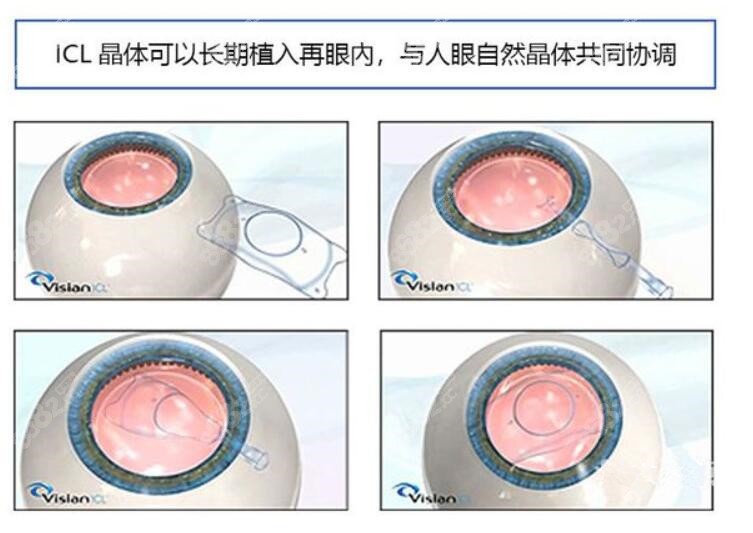 近视做icl晶体植入价格及过程