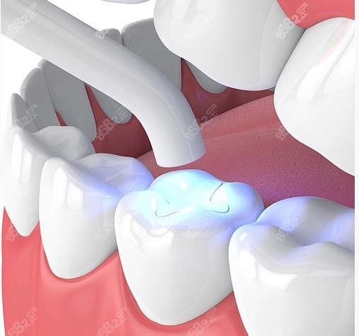 补牙后光固化灯照射