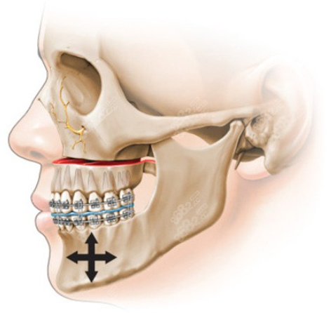 正颌手术图示