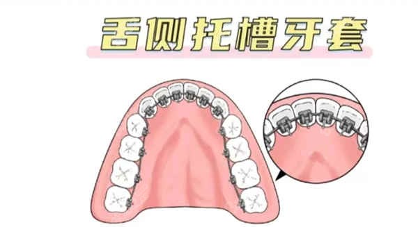 长沙做舌侧矫正费用