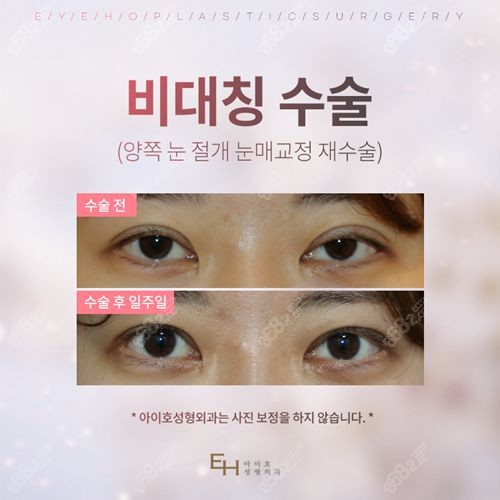 韩国爱护整形医院双眼皮修复对比