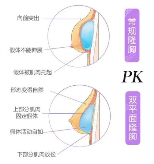 才杰隆胸技术好