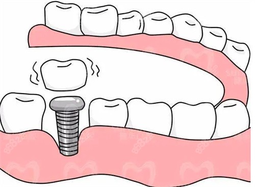 种植牙图片