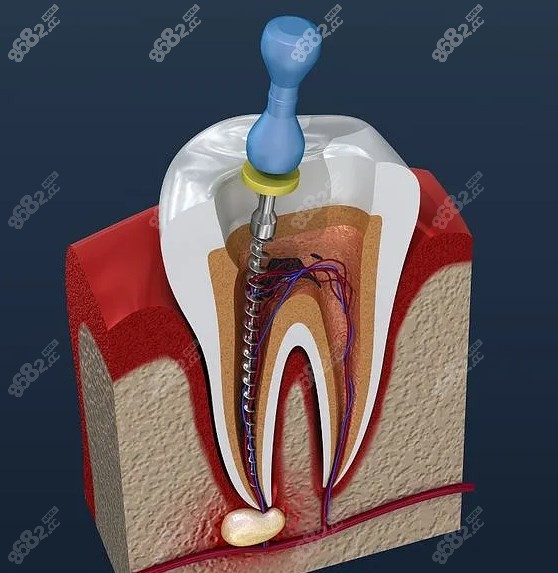 牙科根管治疗